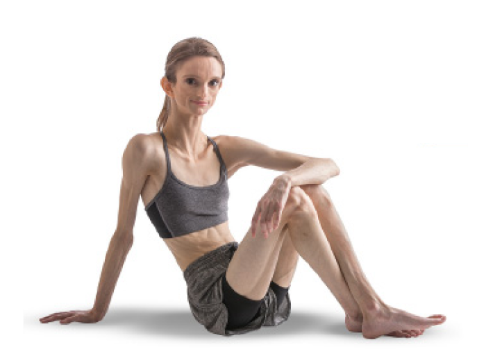 Young woman with GL posing next to a description of Congenital GL