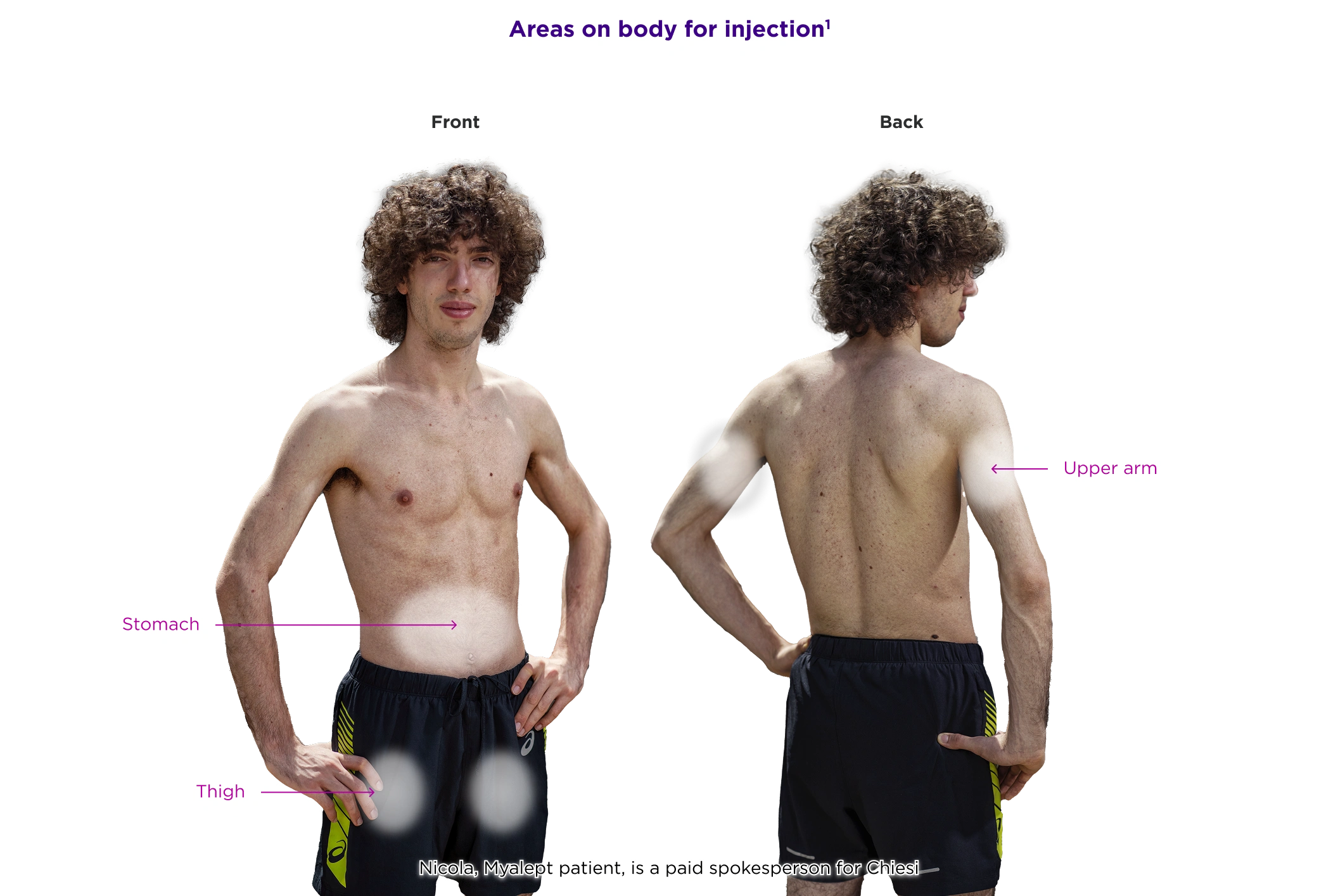 Diagram showing approved Myalept injection sites on the front and back of the body: stomach, thigh, and upper arm